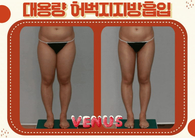 하체 균형을 위한 대용량 허벅지지방흡입