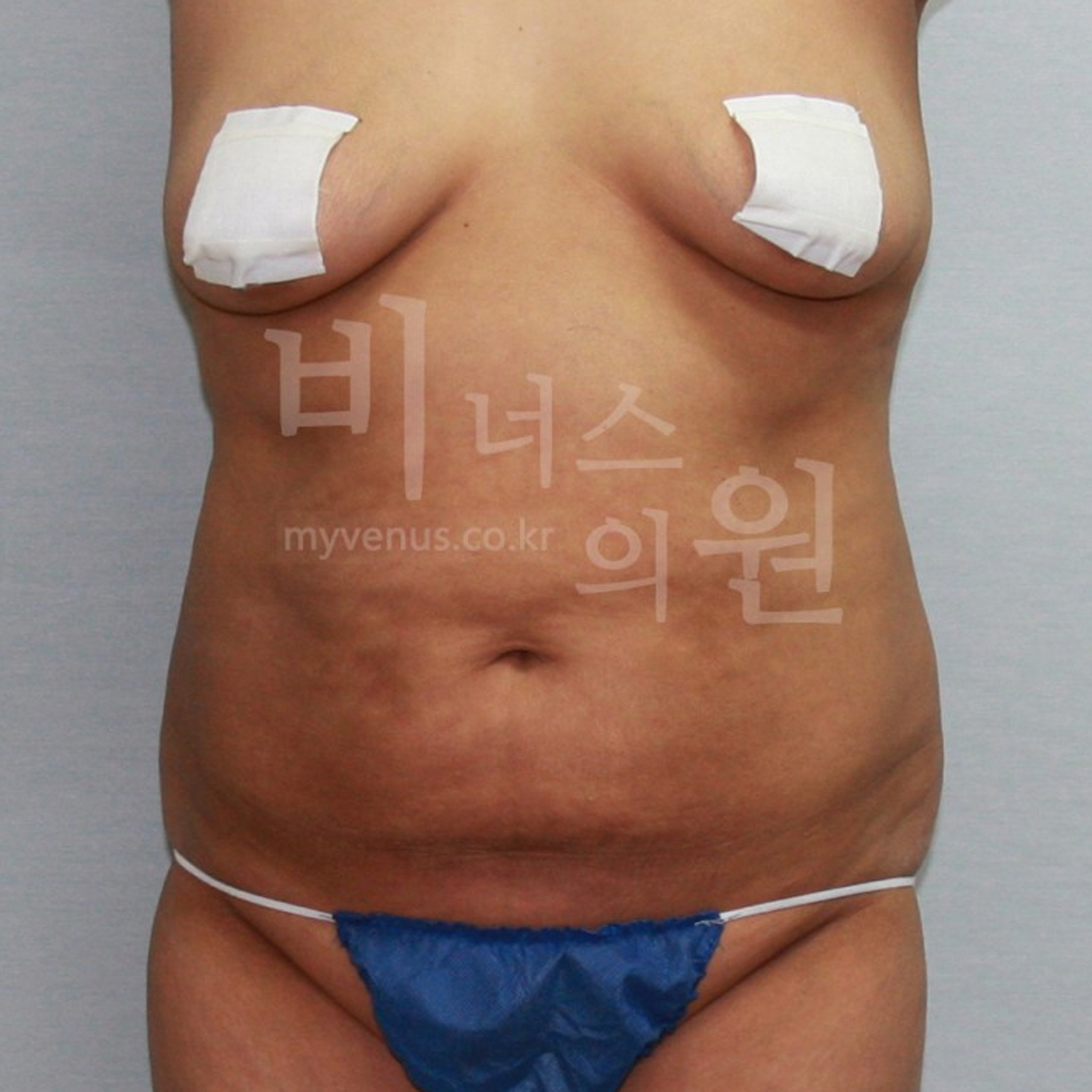 복부지방흡입부작용