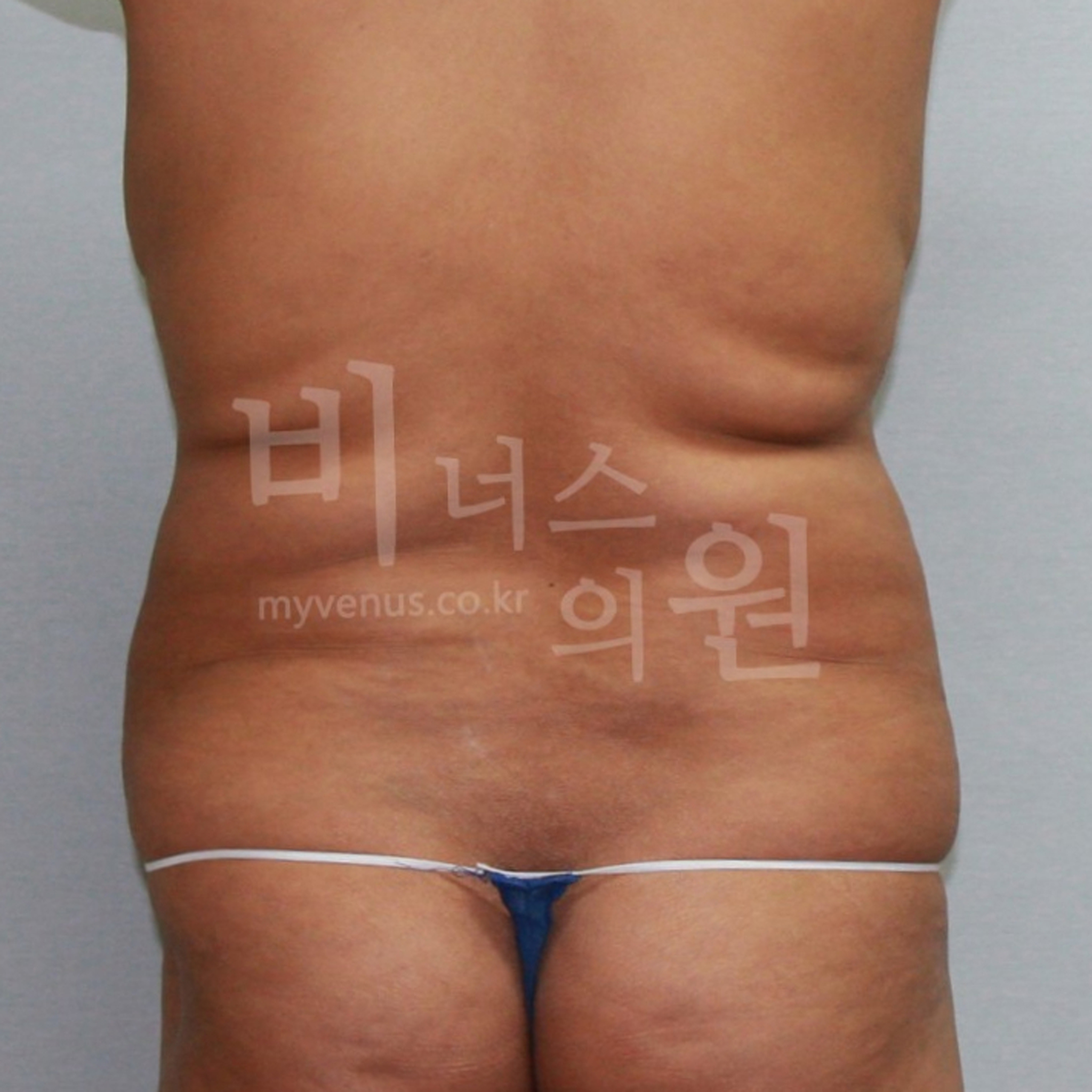 복부지방흡입부작용