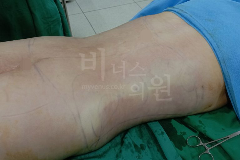 부천 복부 지방흡입 재수술, 남아 있는 불균형까지 고려한 체형 재설계