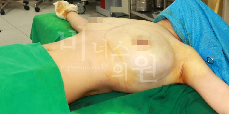 부천지방흡입 유방축소 지방흡입 전후 상체 라인 변화