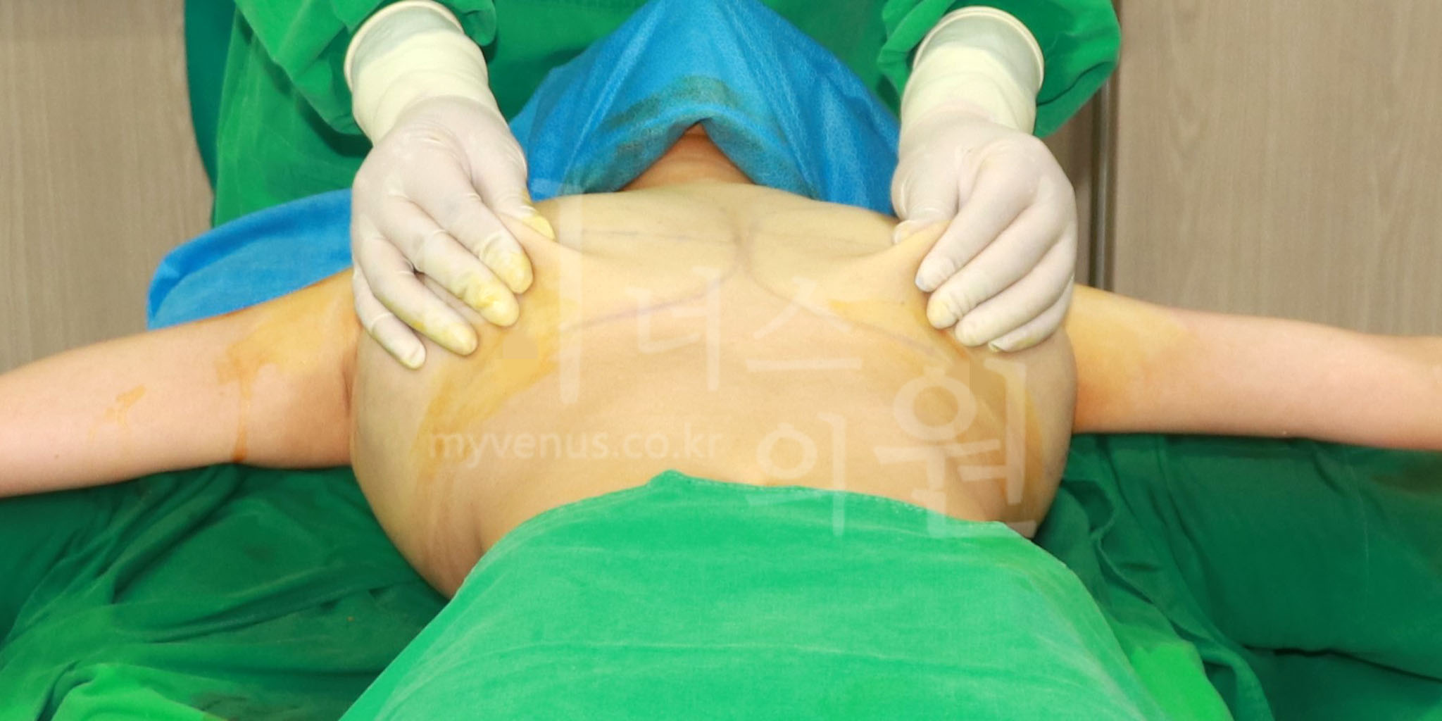 부천지방흡입 유방축소 지방흡입으로 체형에 맞게 개선된 상체 라인