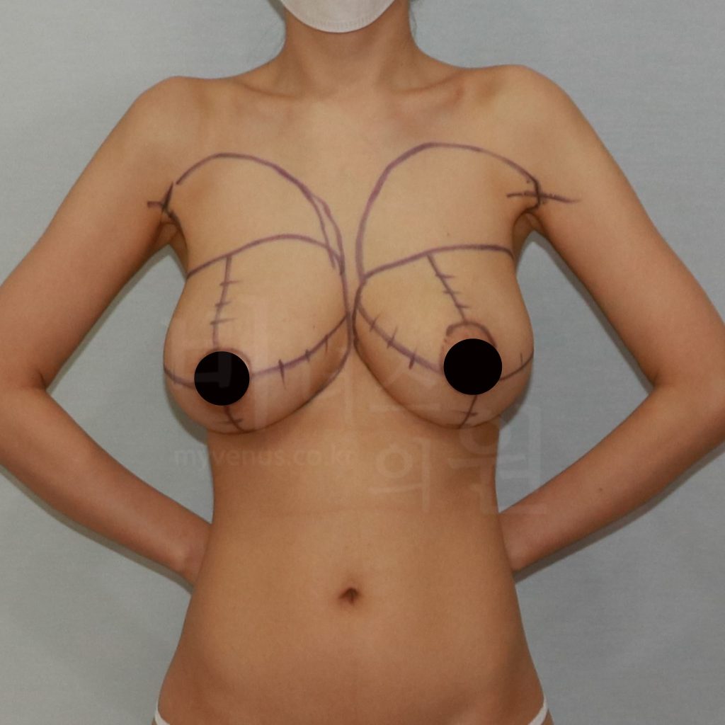 부천지방흡입 유방축소 지방흡입으로 유방과 부유방을 함께 개선한 상체 라인 변화