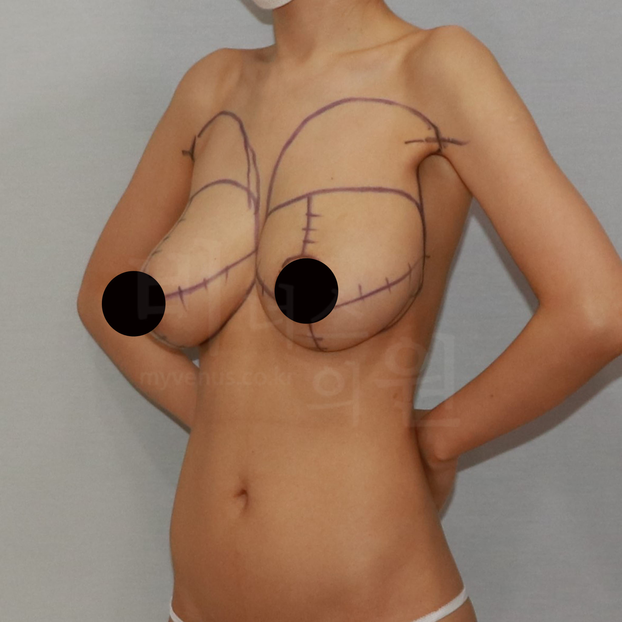 유방축소 지방흡입으로 가슴과 부유방 지방을 정리해 균형 잡힌 상체 라인 개선