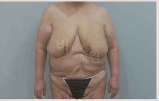 유방축소, 절제법과 지방흡입 중 어떤 선택이 나에게 맞을까