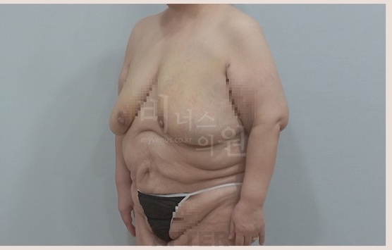 유방축소 지방흡입 수술 후 45도