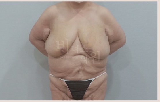 유방축소 지방흡입 수술 후 측면