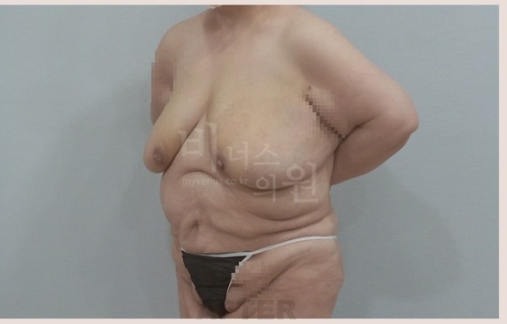 유방축소 지방흡입 수술 후 후면