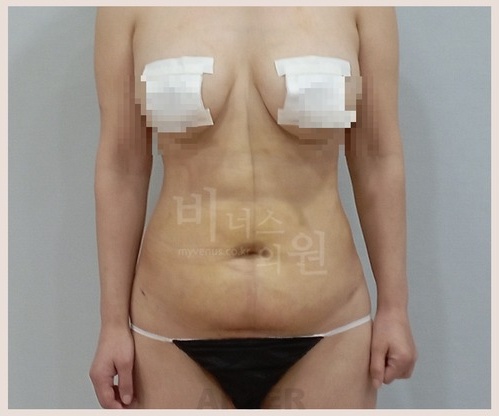 복부 지방흡입, 수술 전 꼭 알아야 할 5가지 체크리스트