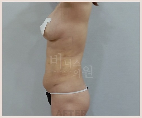 복부 지방흡입 수술 후 우측면