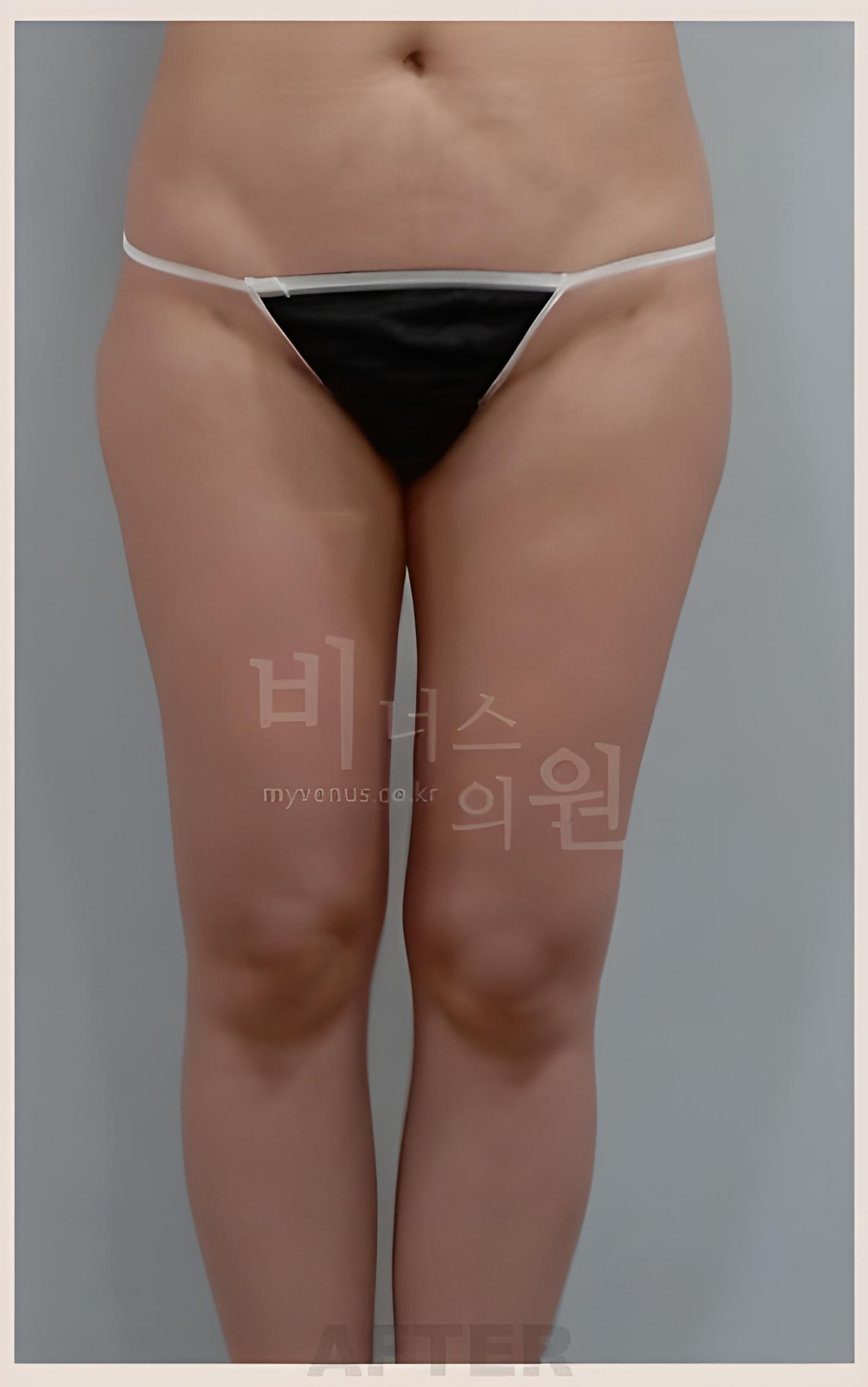 인천지방흡입 허벅지 6개월 후 만세자세