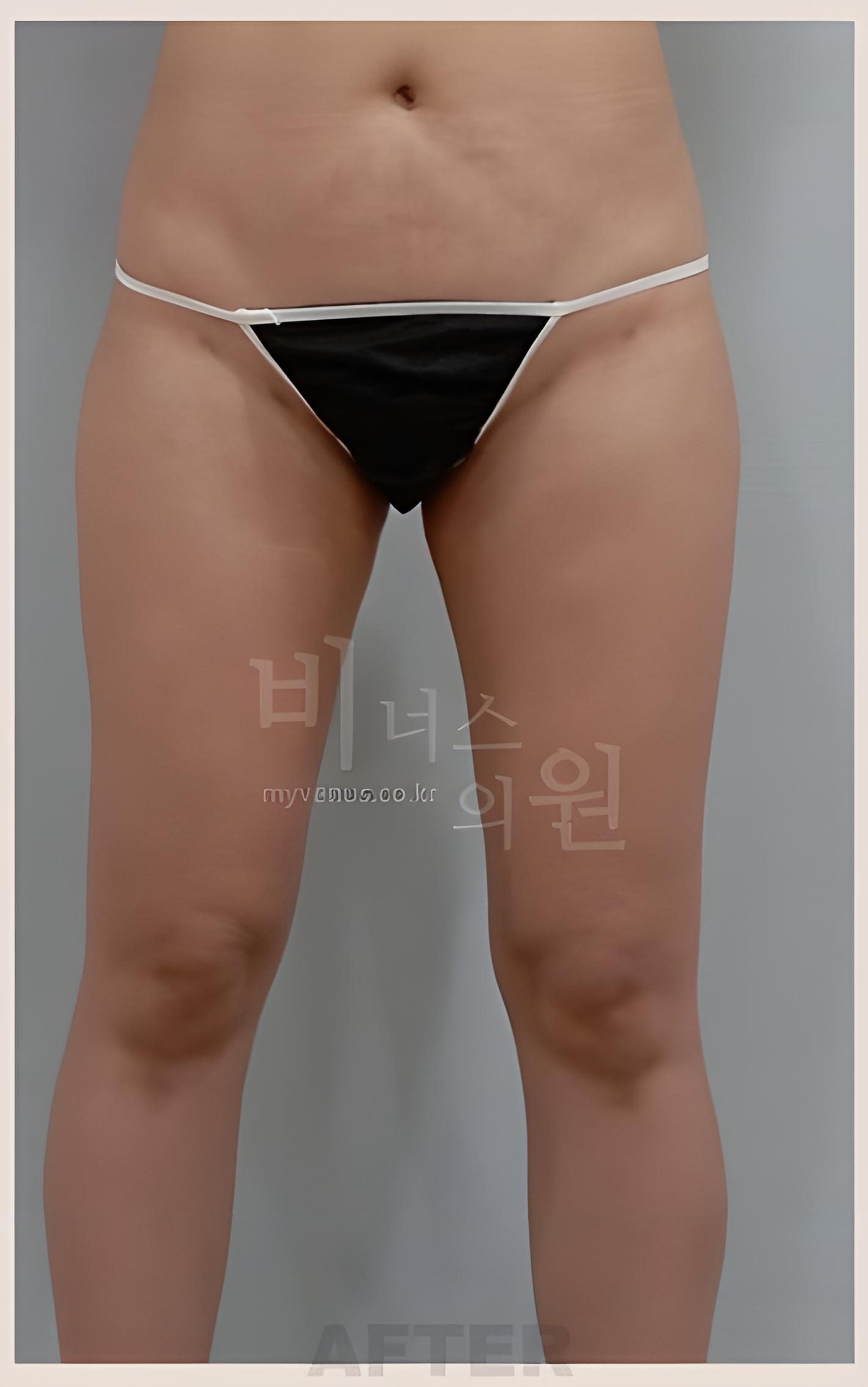 인천지방흡입 허벅지 6개월 후 정면 만세 벌림 — 다리 사이 간격 확인