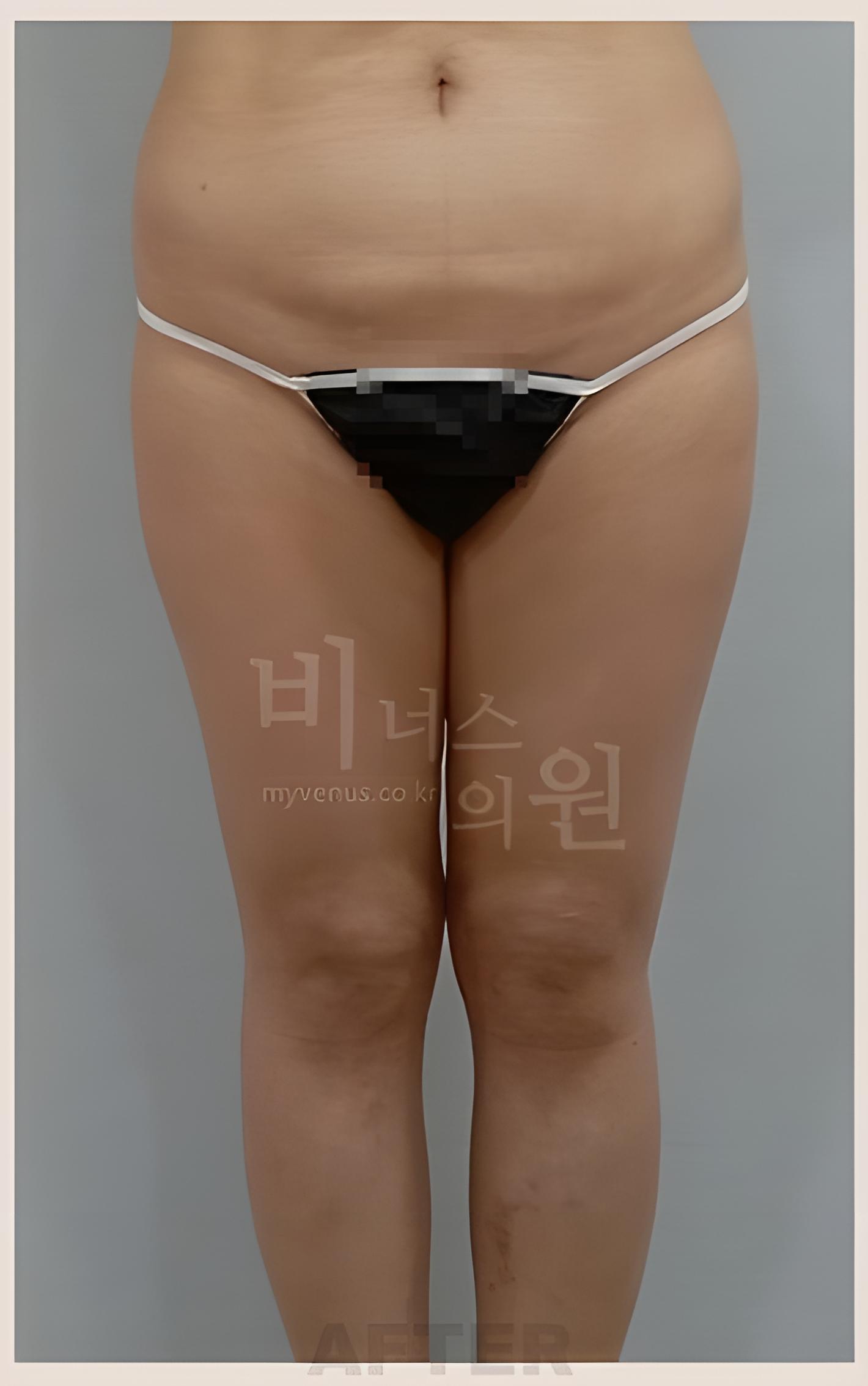 인천지방흡입 종아리 무릎 1주 후 정면