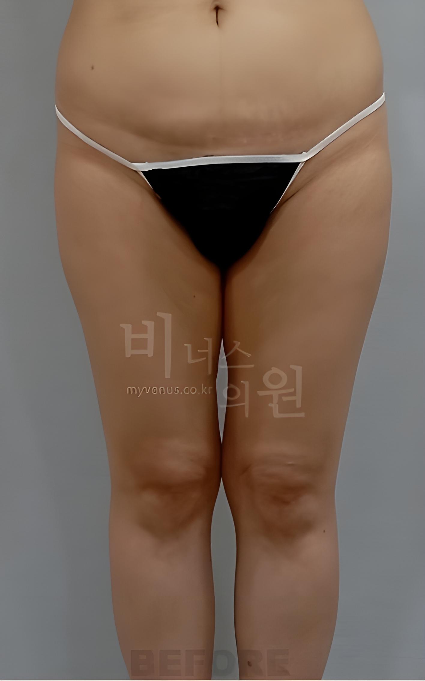 인천지방흡입 종아리 무릎 수술 전 정면
