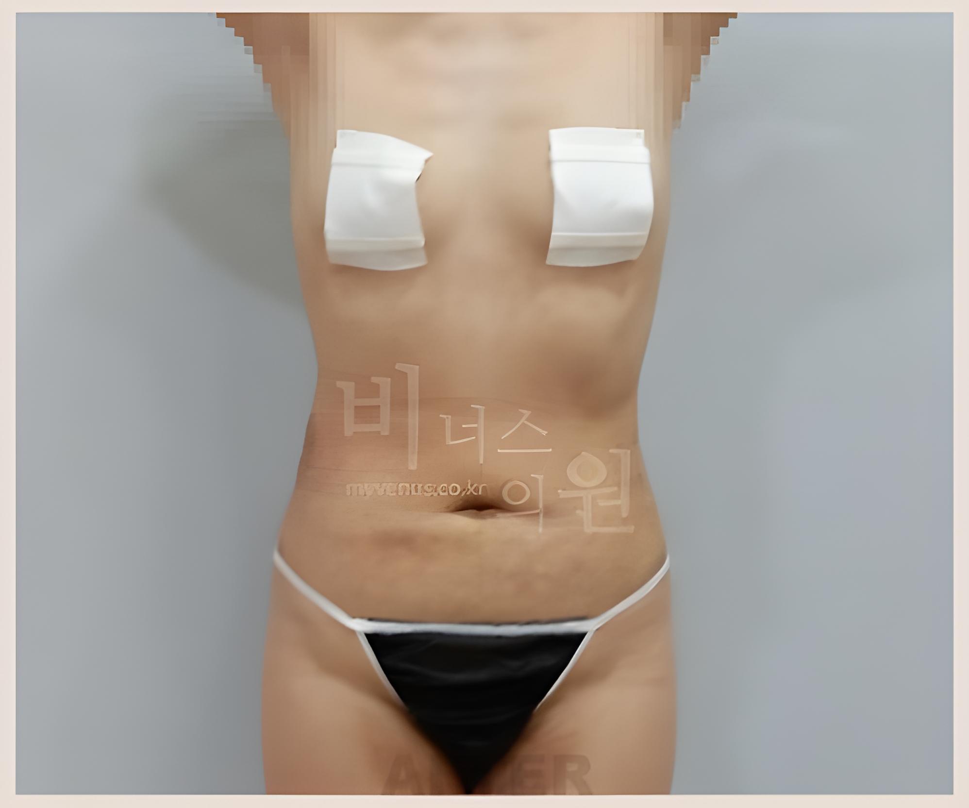 복부 지방흡입 1주 후 정면 만세 자세