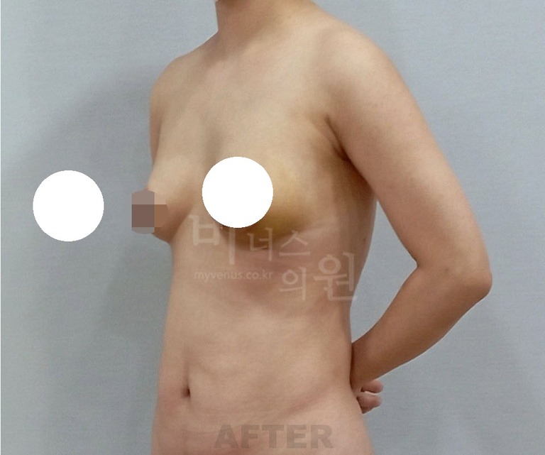 가슴과 등, 상체 전체가 달라졌어요 — 유방축소 지방흡입 복합 수술 1주 전후사진