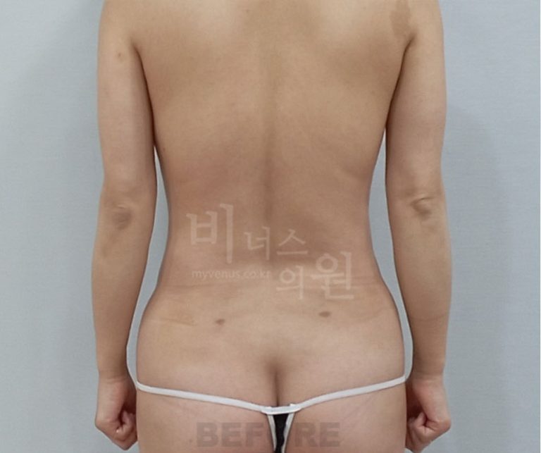 유방축소 뒷구리 요추등 지방흡입 수술 전 후면