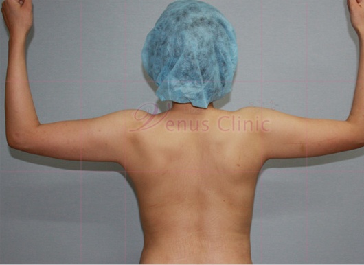 팔 지방흡입 수술 전 정면 — 팔 전체 두께감