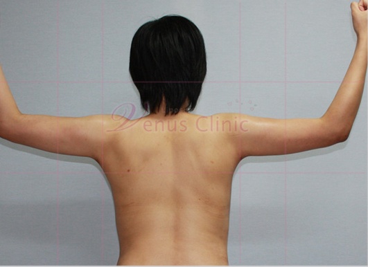 팔 지방흡입 회복 과정 — 경화기부터 일상 복귀까지 단계별로 정리