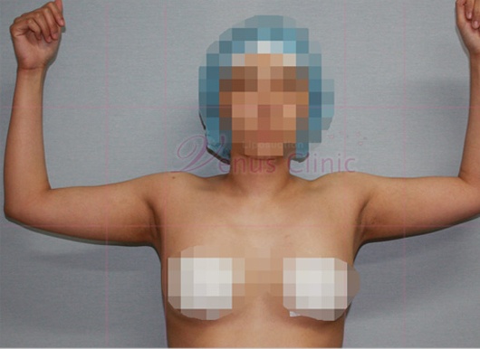 팔 지방흡입 수술 전 후면 — 팔 뒤쪽 겨드랑이 부위