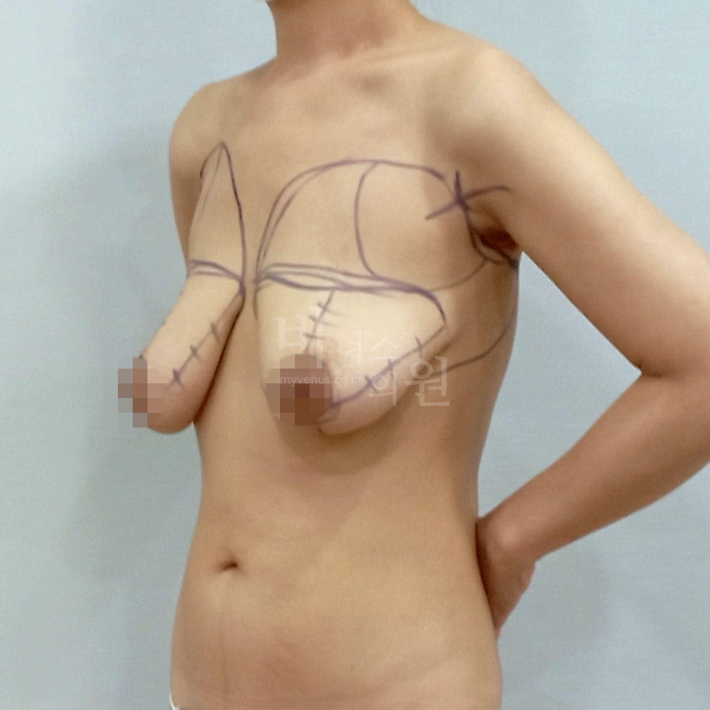 가슴 크기와 처짐을 분석해 디자인한 유방축소 지방흡입 계획