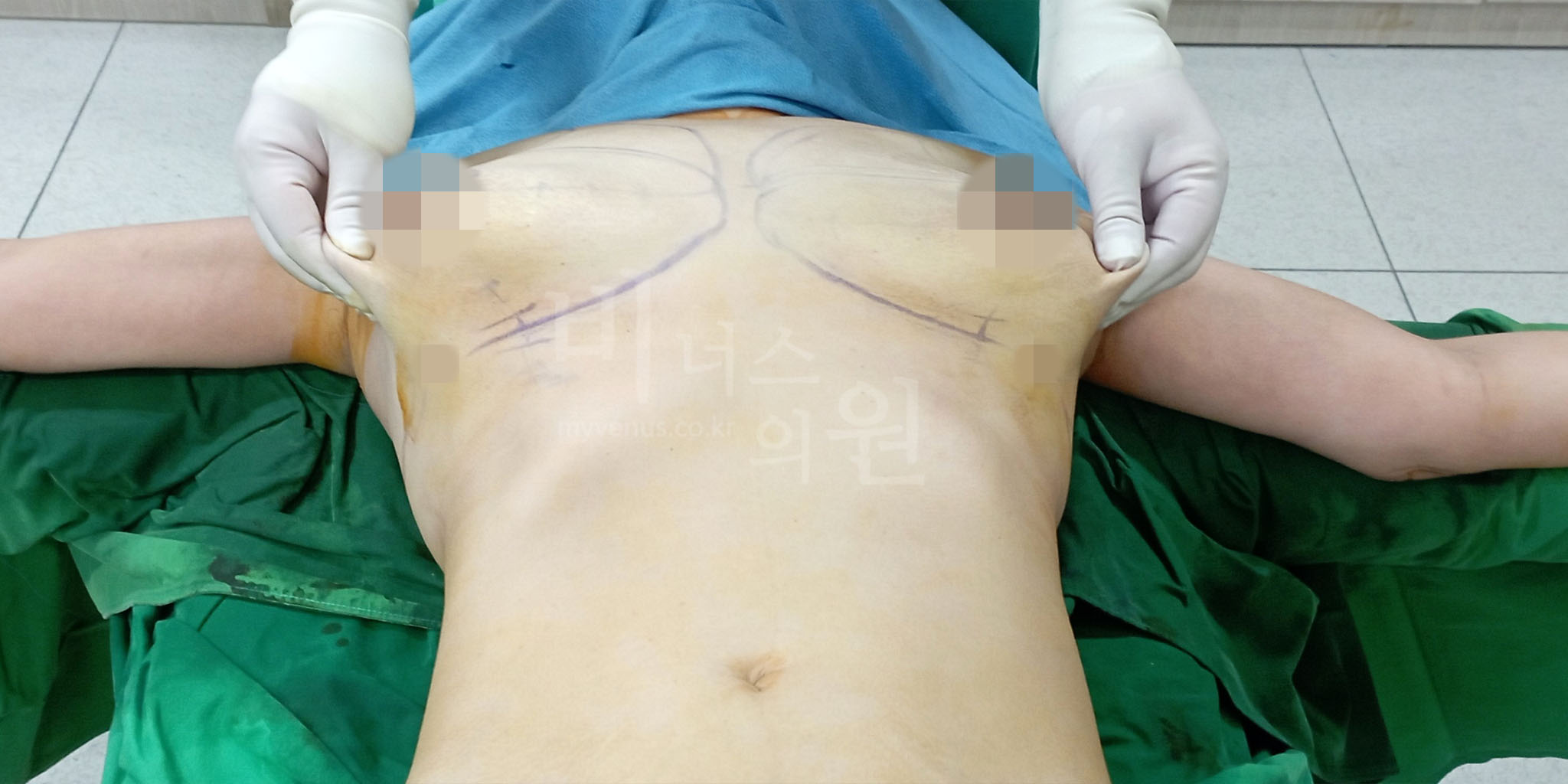 부천 비너스의원 가슴 지방흡입 상담 안내