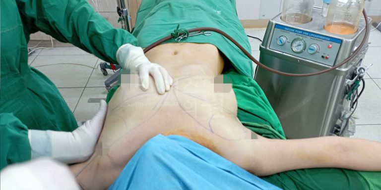 부천지방흡입 가슴축소 지방흡입으로 개선된 가슴거상술 효과, 가슴 라인 전후