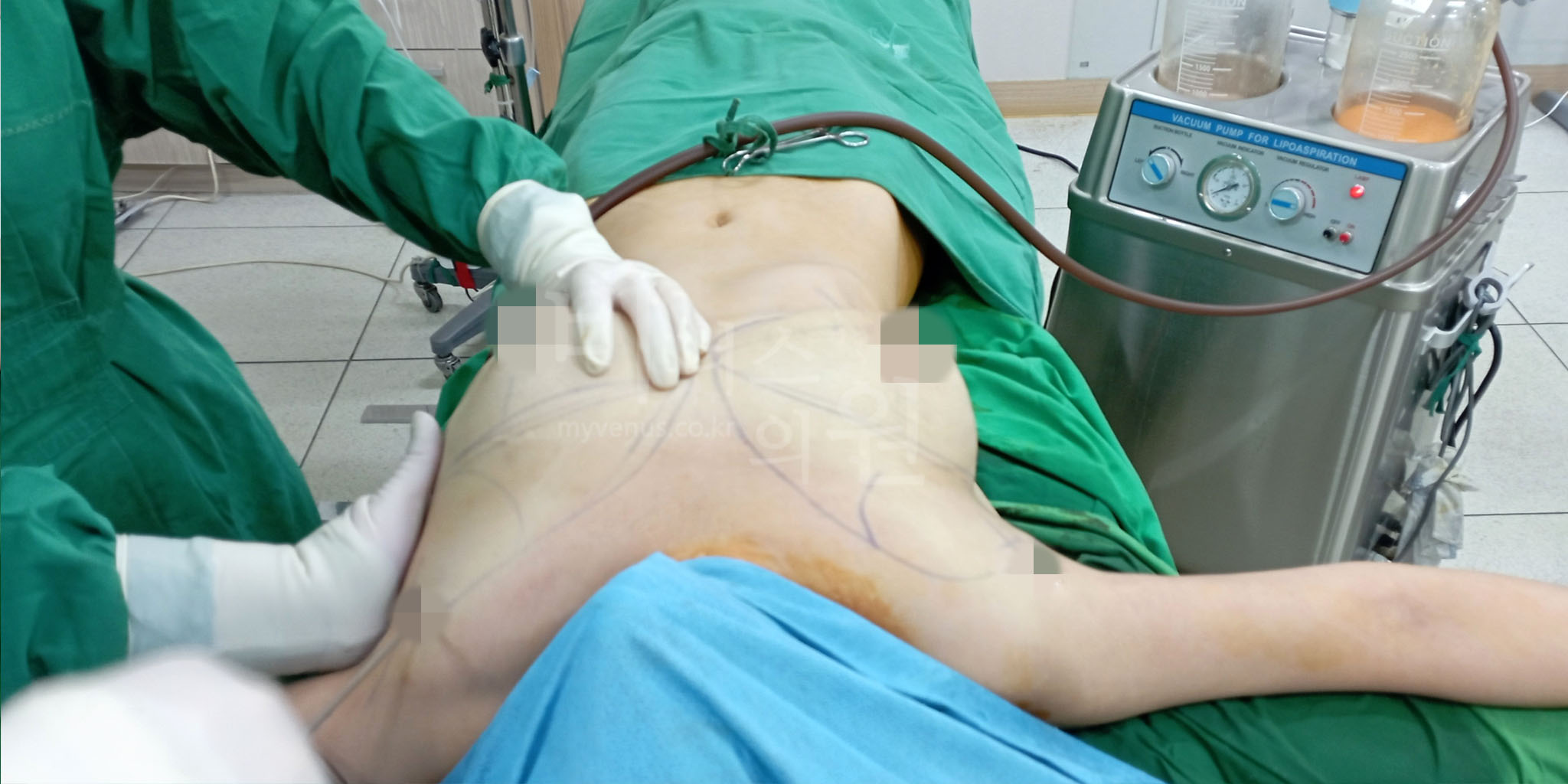 부천지방흡입 가슴축소 지방흡입으로 개선된 가슴거상술 효과, 가슴 라인 전후