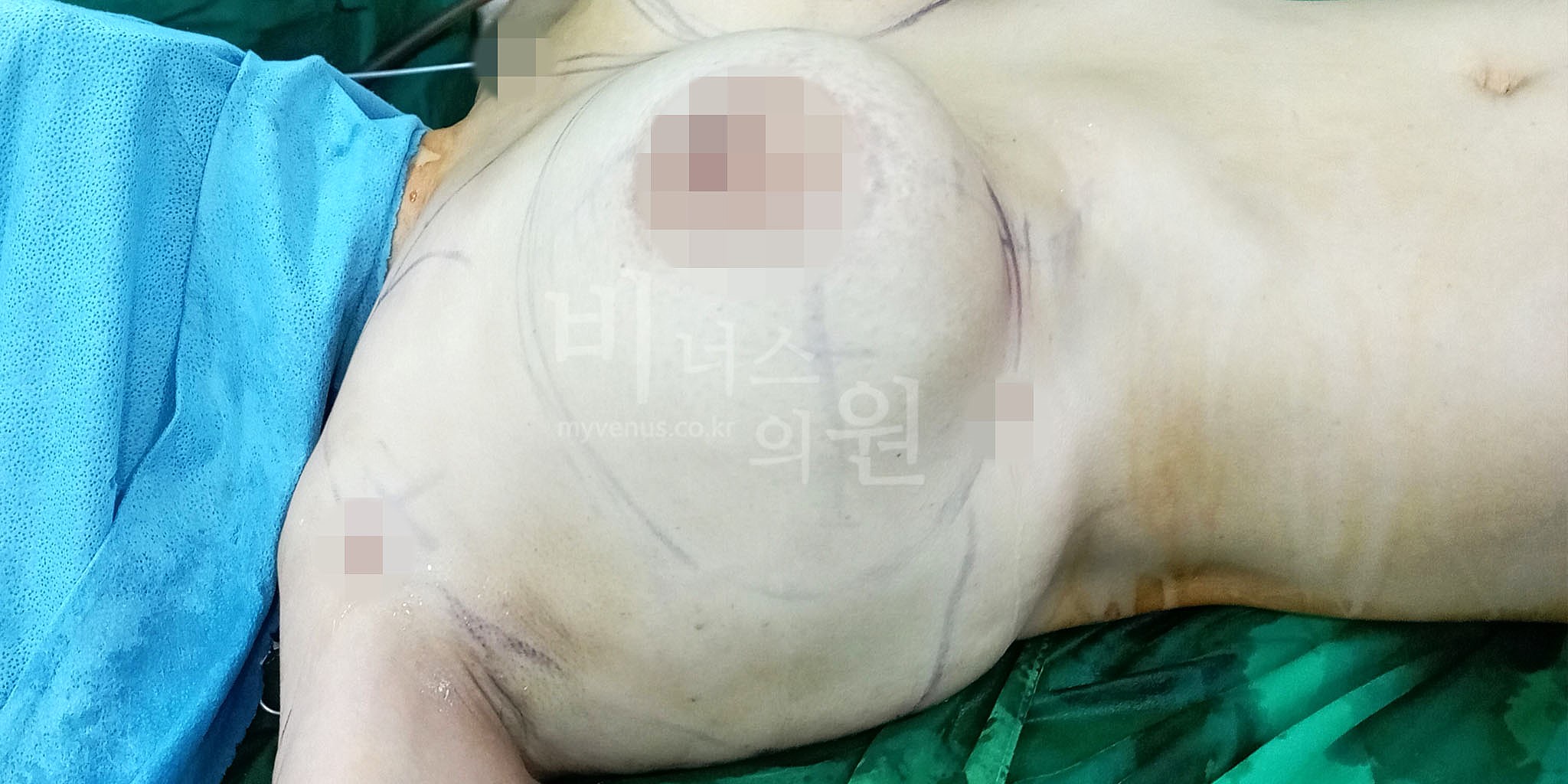 가슴 하부 지방과 처짐이 있는 가슴 라인 상태