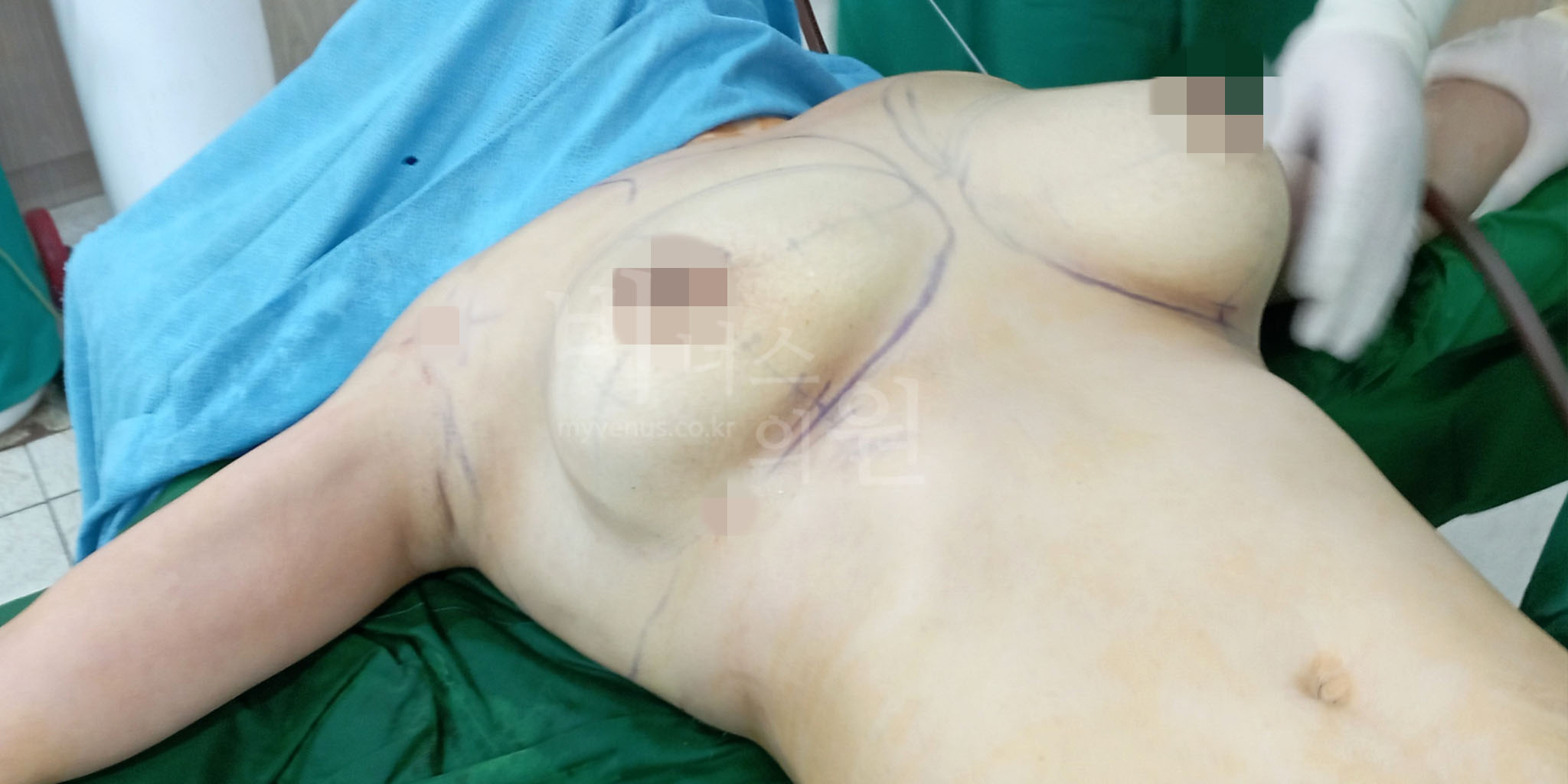 가슴 지방흡입 후 정리된 가슴 라인 변화