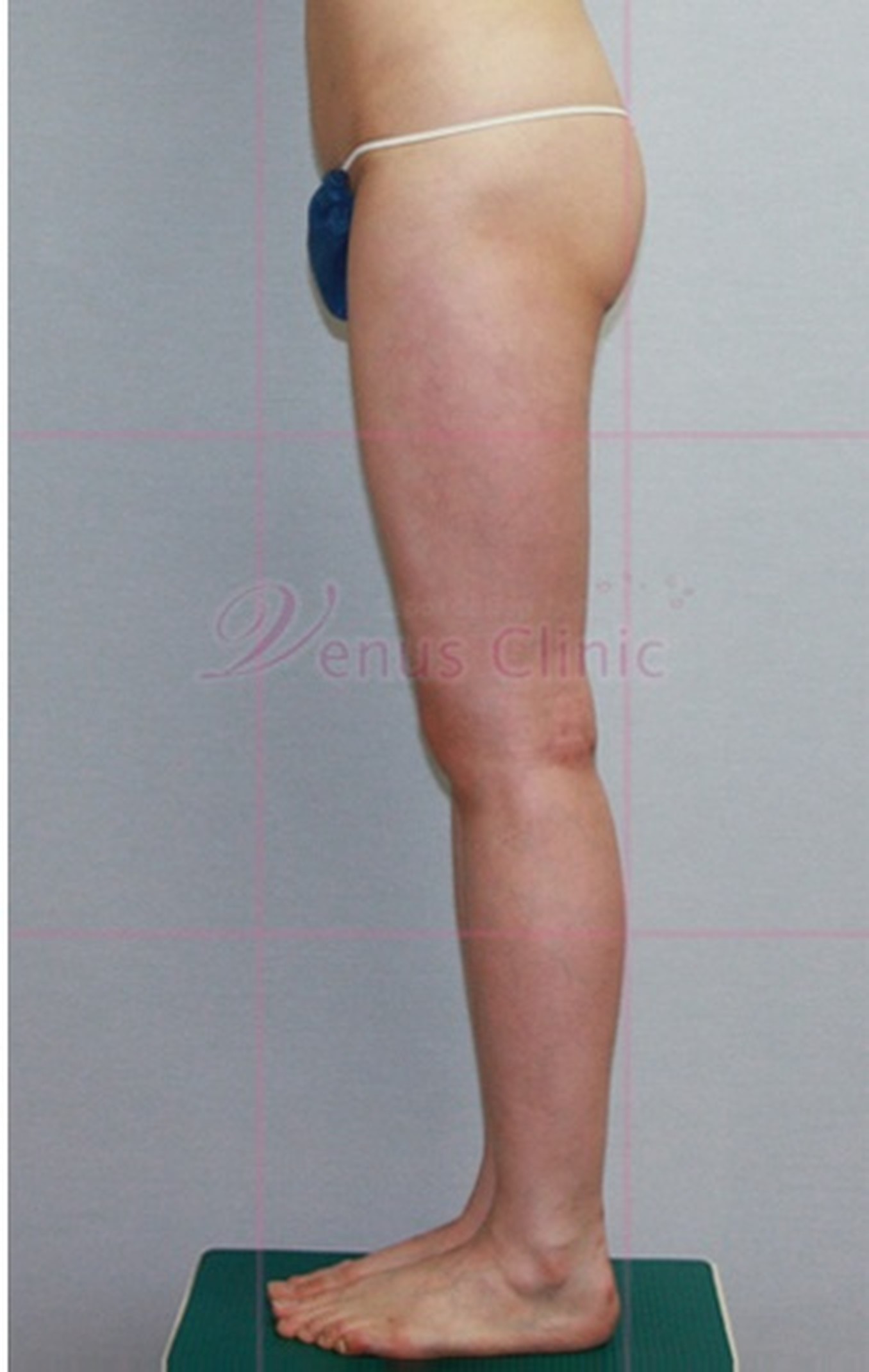 엉덩이축소 지방흡입 수술 후 후면 — 승마바지 뒤태 개선 결과 비너스의원