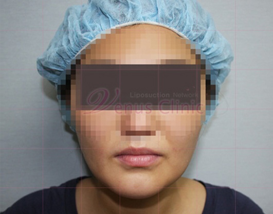 이중턱 지방흡입 경험담 — 상담부터 수술 당일, 한 달 회복까지