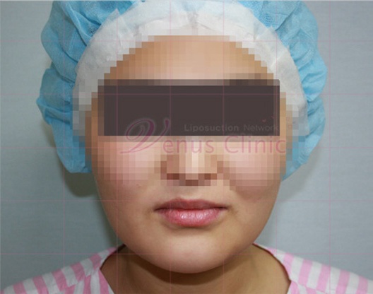 이중턱 지방흡입 전후사진 정면 수술 전 — 턱밑 지방이 두드러진 상태