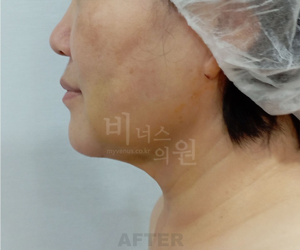 이중턱 목라인 지방흡입 측면 수술 후 비너스의원