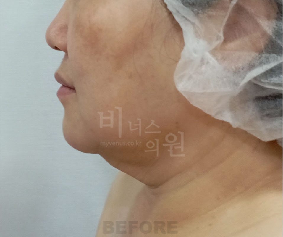 이중턱 목라인 지방흡입 측면 수술 전 비너스의원