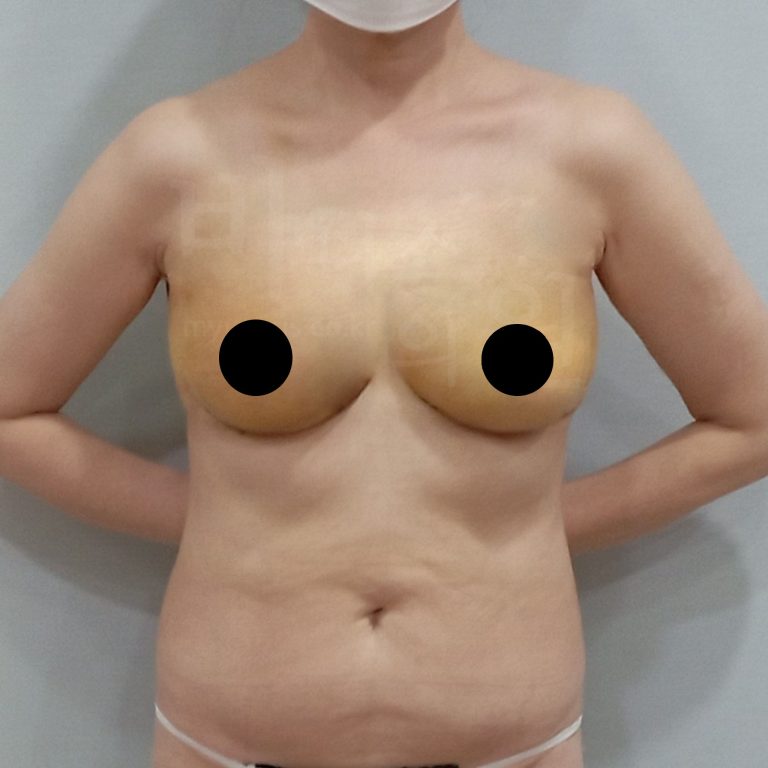 가슴 지방흡입 수술 후 정면