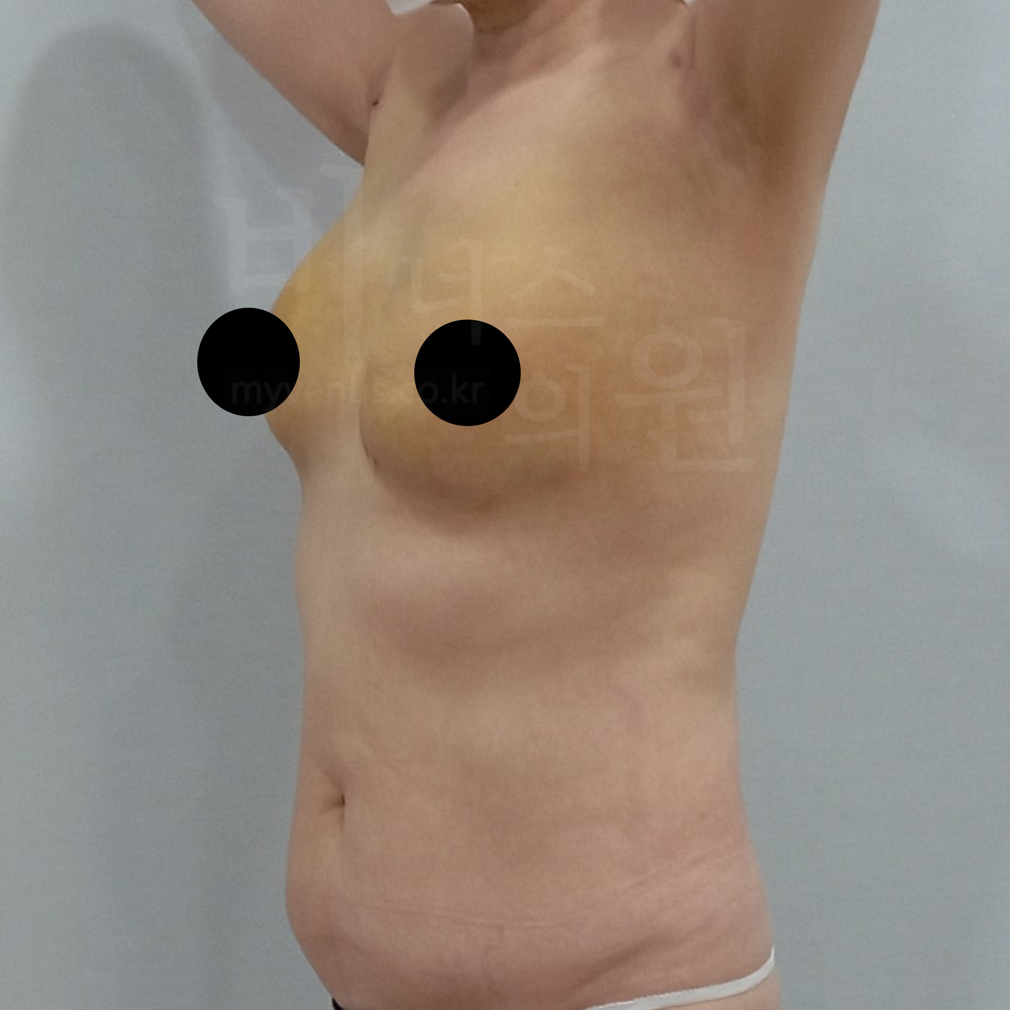 가슴축소 지방흡입 수술 후 — 사면 촬영