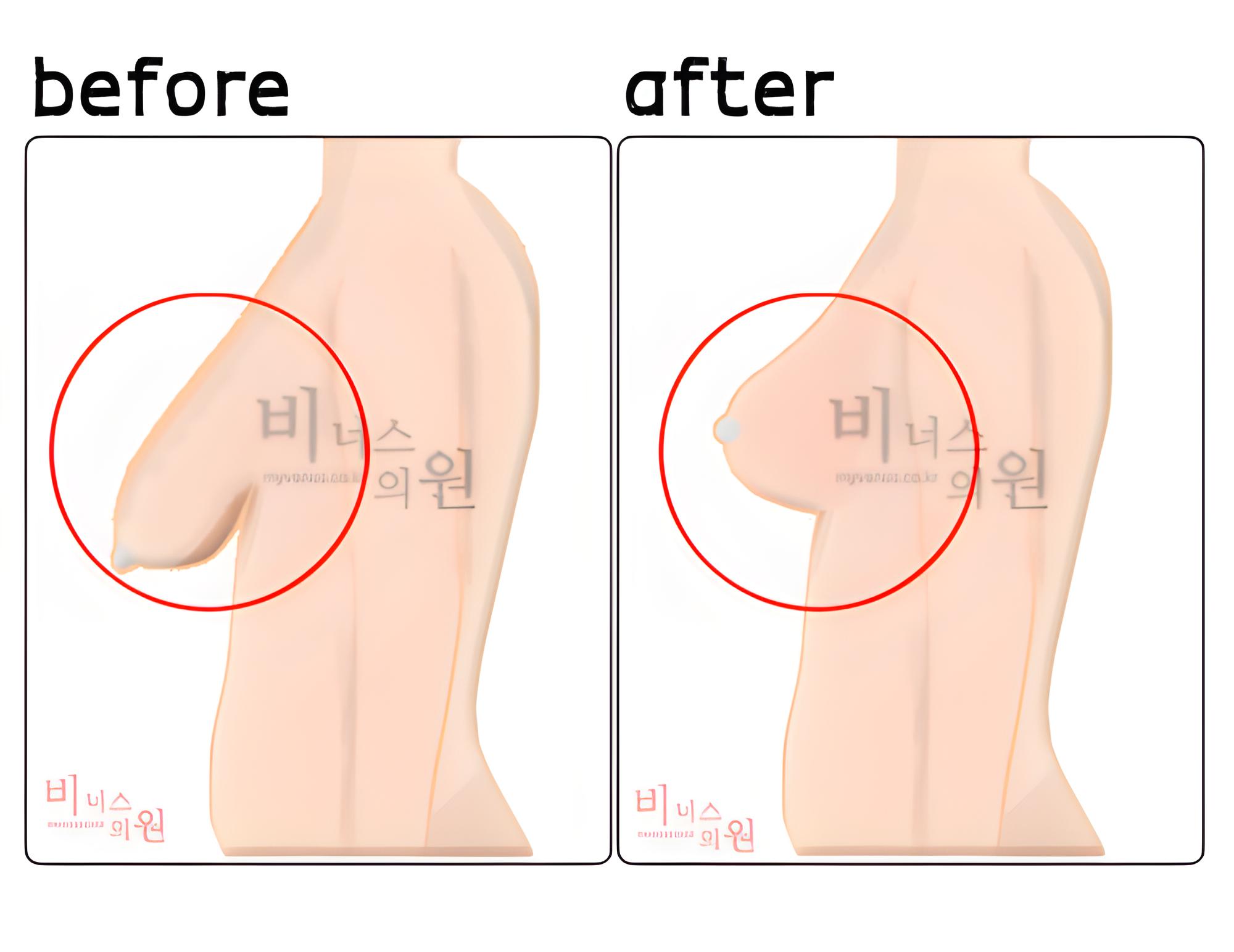 가슴축소 지방흡입 수술 상담 이미지 — 비너스의원 유방 지방흡입 부천 상동역