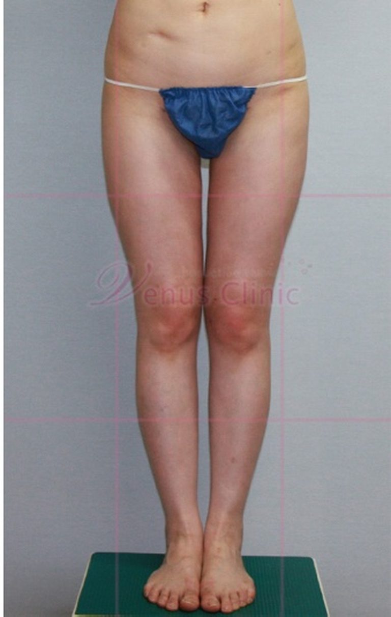 엉덩이지방흡입, 수술 전 몰랐던 것들 — 체형별 접근과 회복 경험 정리