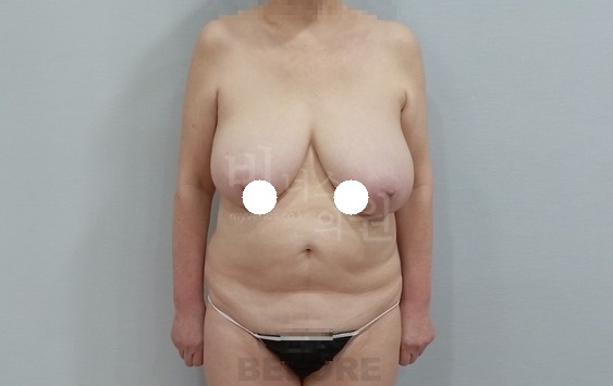 가슴축소 지방흡입 전 정면 — 유방+부유방+겨드랑이 부천 비너스의원