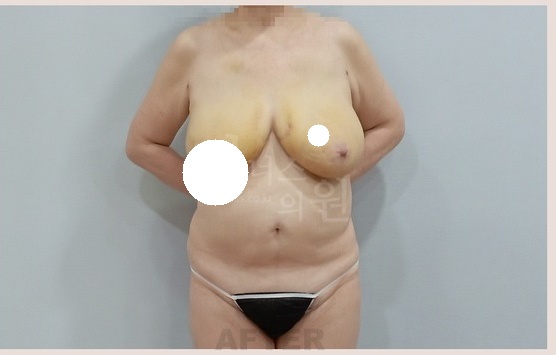 가슴축소 지방흡입 후 1주 열중쉬어 자세 — 부유방+겨드랑이 부천 비너스의원