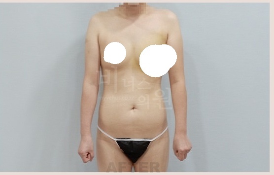 가슴축소 지방흡입 후 회복 기간, 1주부터 1개월까지 실제 변화와 관리법