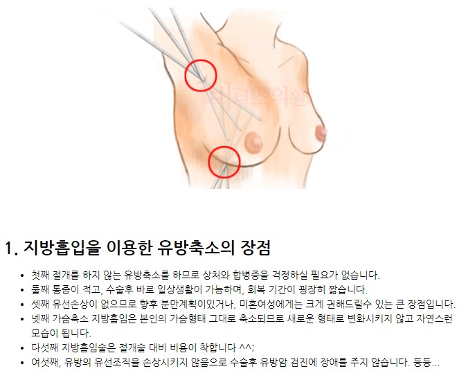 가슴축소 지방흡입 장점 인포그래픽 — 흉터 없음 당일퇴원 빠른회복
