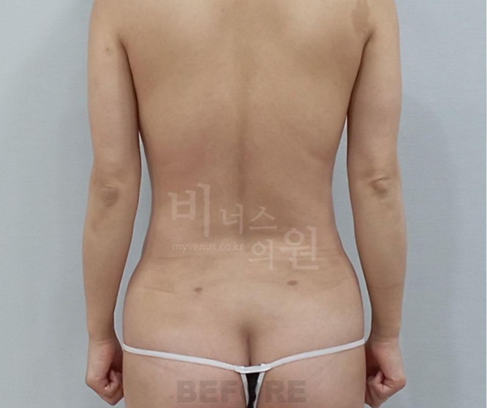 유방축소 지방흡입 수술 전 후면 — 뒷구리하방과 요추등 볼륨으로 등 하부 라인이 무거운 모습