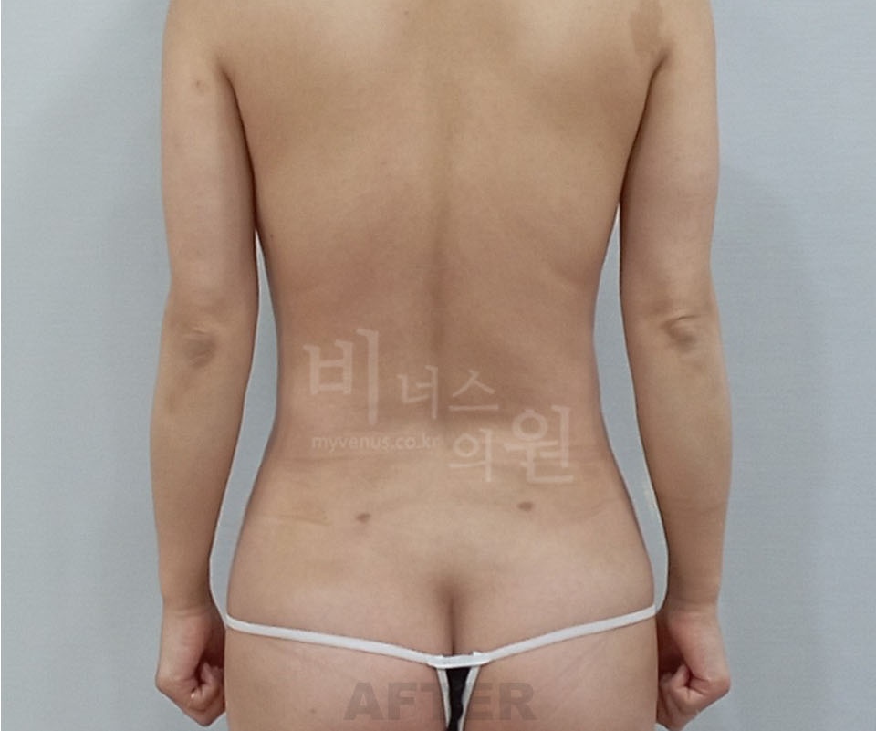 유방축소 지방흡입 수술 후 후면 1주 — 등 하부 볼륨이 완화되고 뒤태 라인이 정돈된 모습