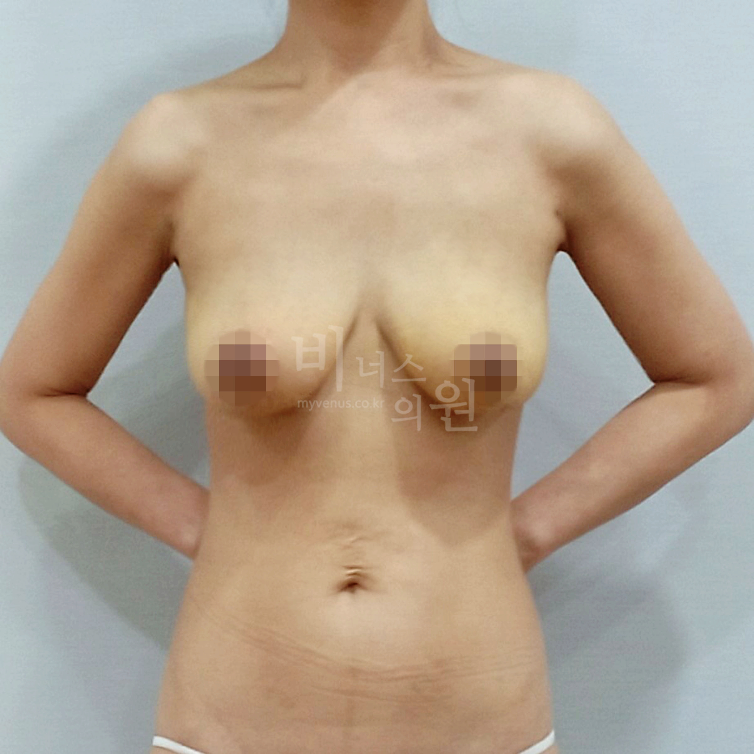 가슴 라인 디자인 후 사이즈 축소와 리프팅으로 정리된 가슴 라인