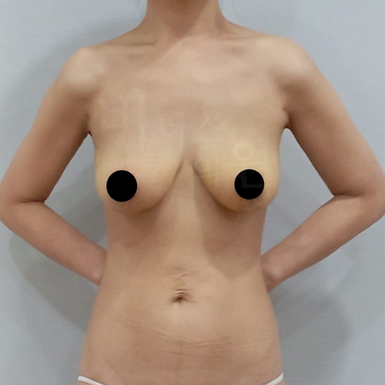 가슴축소 지방흡입 수술 후 정면