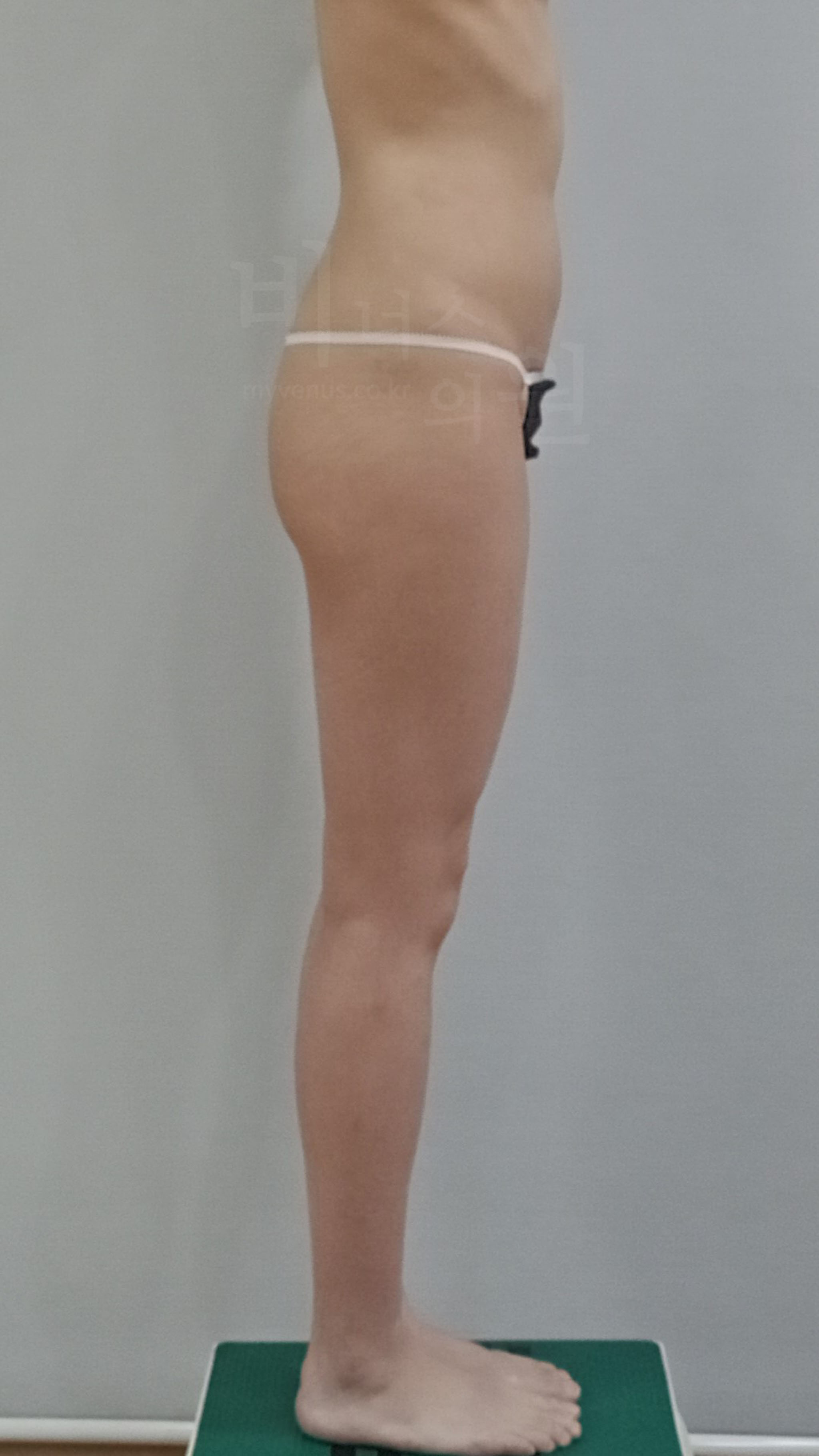 엉덩이지방흡입 수술 전 측면 — 비너스의원 전후사진