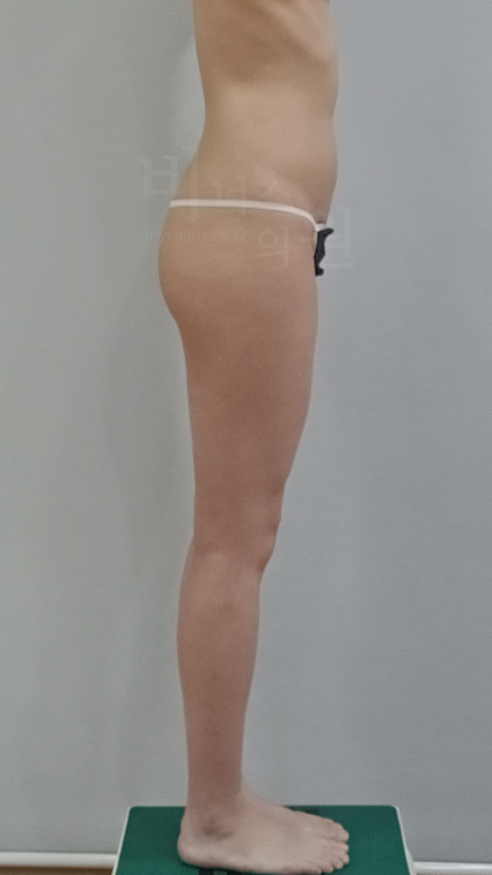 엉덩이지방흡입 수술 후 측면 — 비너스의원 전후사진