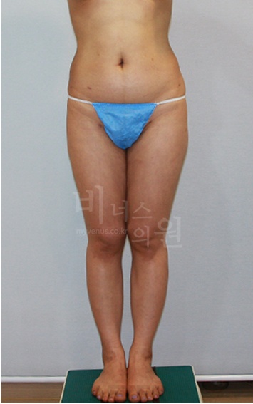 허벅지지방흡입 회복 후기: 수술 당일부터 1주일까지 실제 경험담